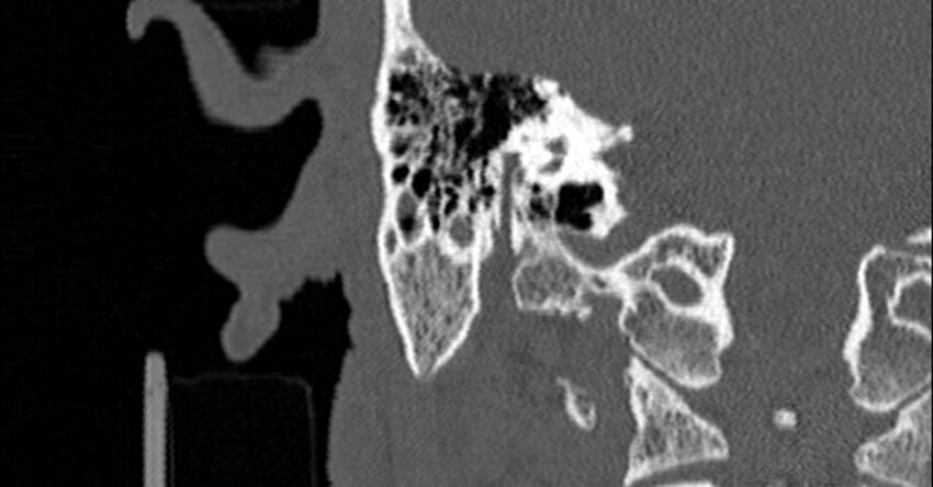 Bilateral temporal bone fractures (Radiopaedia 29482-29970 Coronal non-contrast 129).jpg