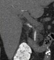 Bile leak from accessory duct(s) of Luschka post cholecystectomy (Radiopaedia 40736-43389 B 36).jpg