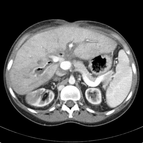 File:Biliary necrosis - liver transplant (Radiopaedia 21876-21846 B 24).jpg