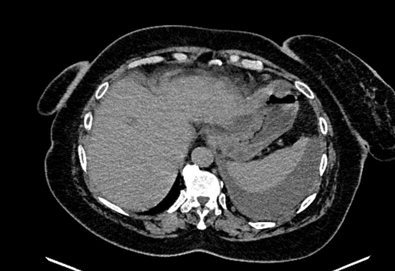File:Biliary pancreatitis (Radiopaedia 72289-82823 Axial non-contrast 55).jpg