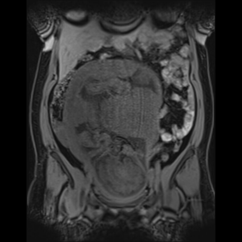 Bilobed placenta accreta (Radiopaedia 69648-79591 Coronal T1 vibe 80).jpg