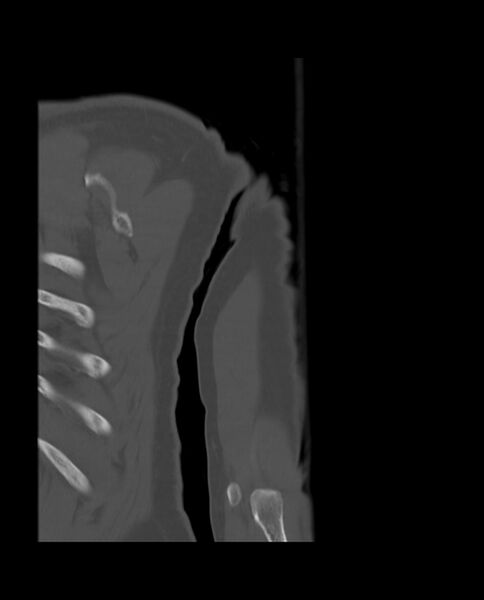 File:Bizarre parosteal osteochondromatous proliferation (Radiopaedia 84221-99501 Coronal bone window 29).jpg
