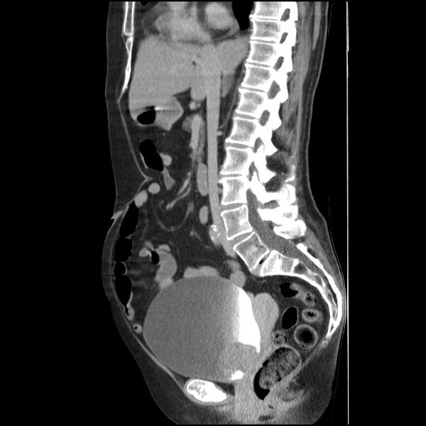 File:Bladder tumor detected on trauma CT (Radiopaedia 51809-57609 E 39).jpg
