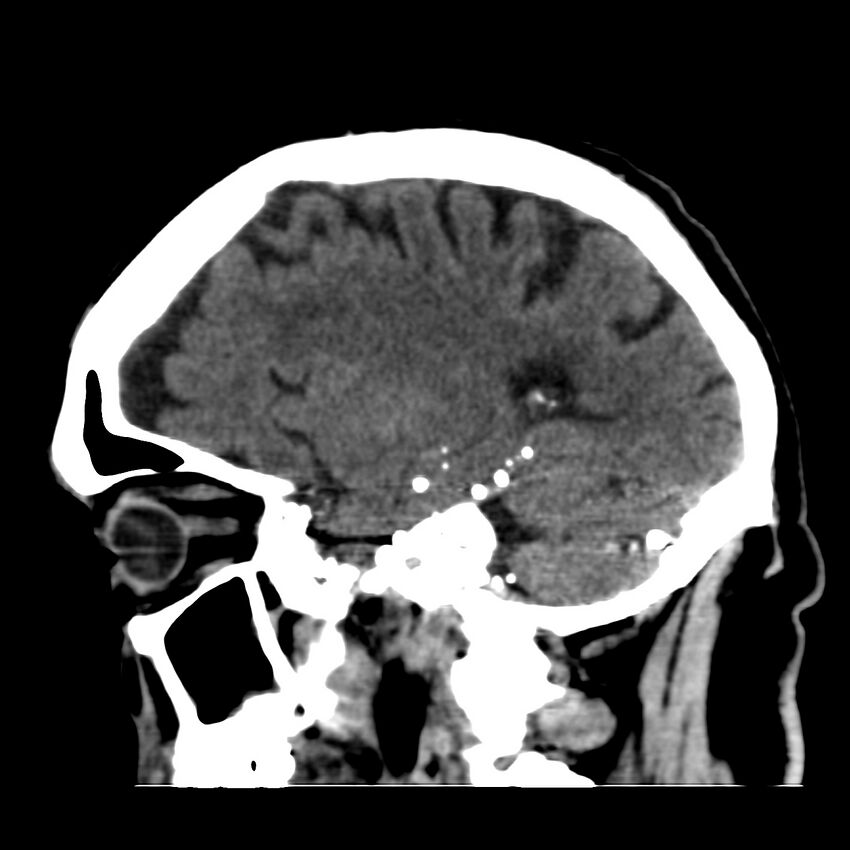 Brain Pantopaque remnants (Radiopaedia 78403-91048 C 39).jpg