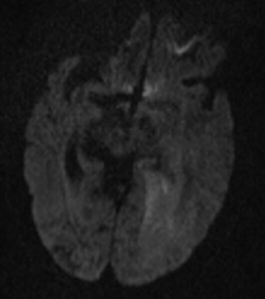 File:Brain abscess with dual rim sign (Radiopaedia 87566-103938 Axial DWI 8).jpg