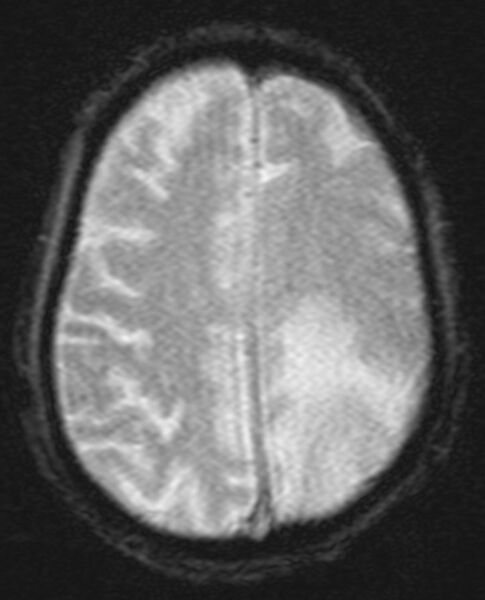 File:Brain abscess with dual rim sign (Radiopaedia 87566-103938 Axial SWI 17).jpg