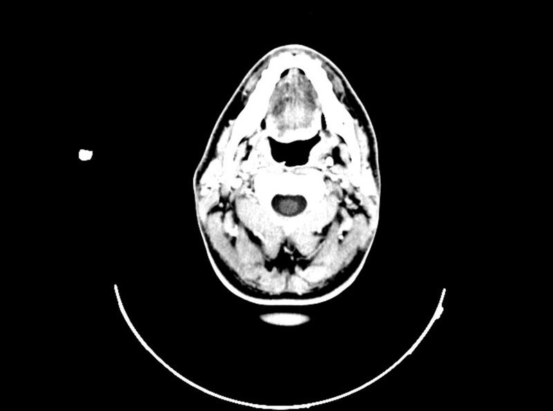 File:Brain injury by firearm projectile (Radiopaedia 82068-96088 B 43).jpg