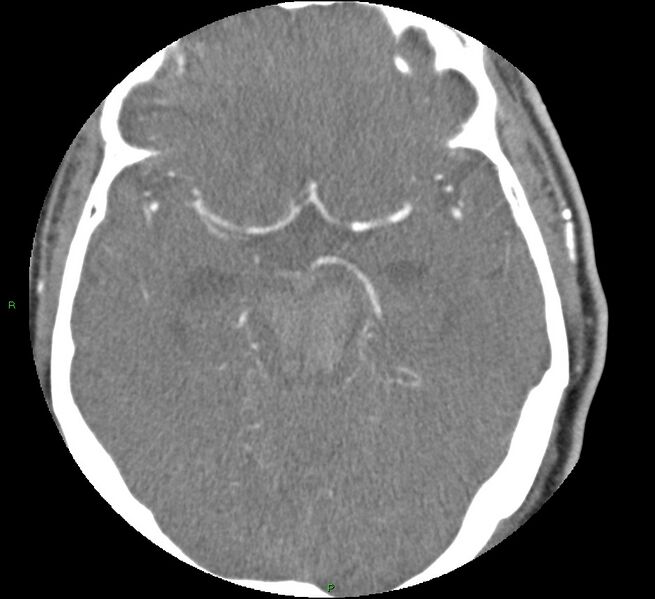 File:Brainstem hemorrhage (Radiopaedia 58794-66028 D 79).jpg