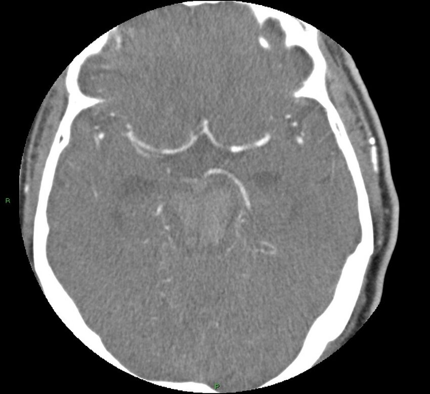 Brainstem hemorrhage (Radiopaedia 58794-66028 D 79).jpg