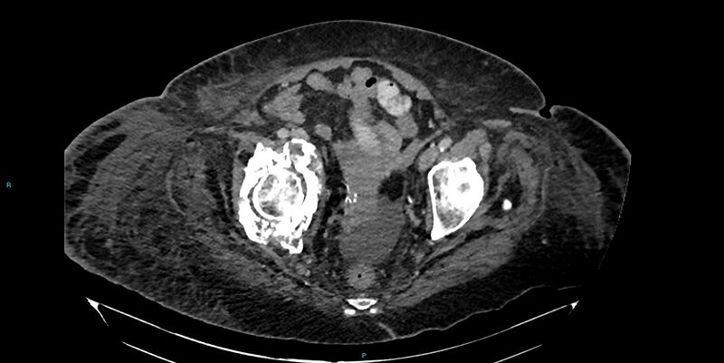 File:Breast cancer pelvic bony metastases (Radiopaedia 84470-99824 Axial bone window 51).jpg