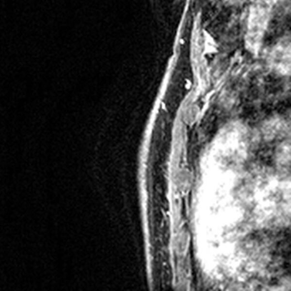 File:Breast implants - MRI (Radiopaedia 26864-27035 Sagittal T2 51).jpg