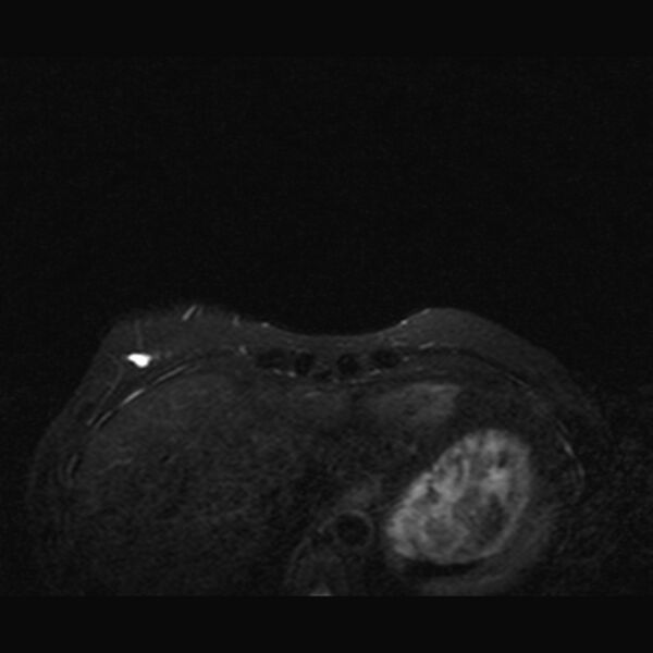 File:Breast implants - MRI (Radiopaedia 26864-27035 T2 SPAIR 5).jpg