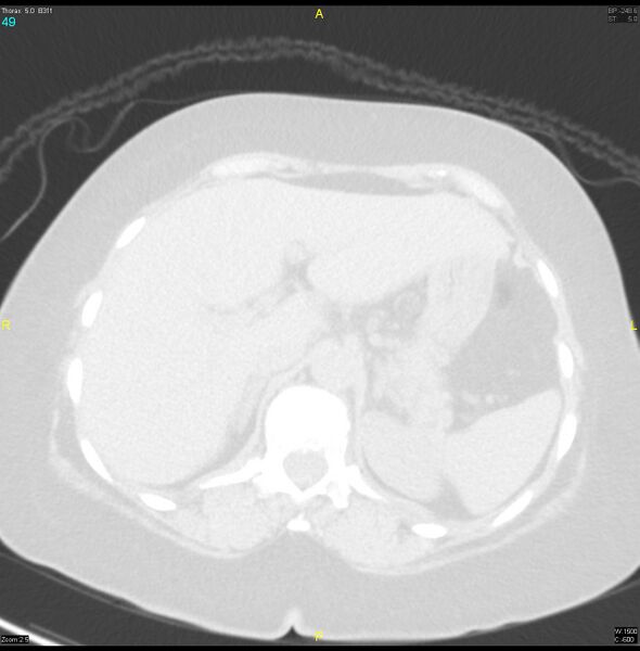 File:Breast primary with lung and bone metastases (Radiopaedia 40620-43228 Axial lung window 49).jpg