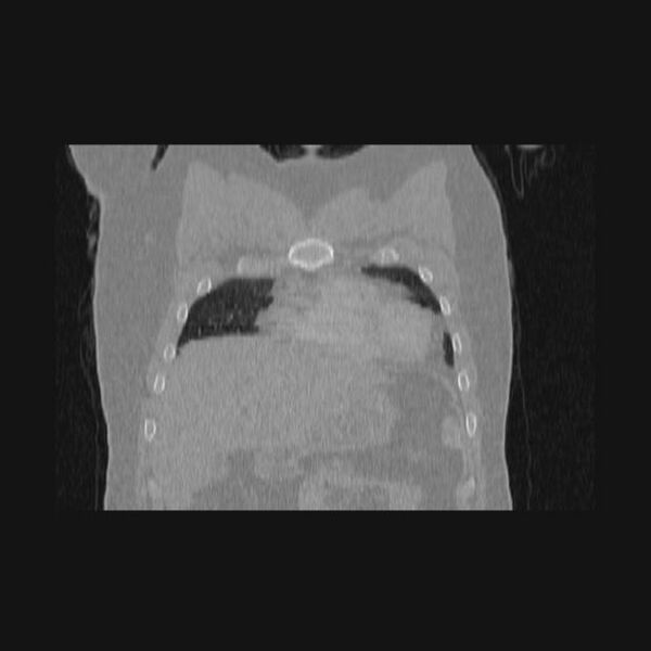 File:Bronchial atresia (Radiopaedia 60685-68439 Coronal lung window 62).jpg