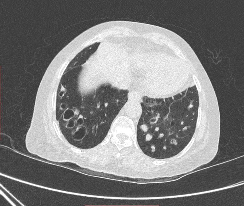 Bronchiectasis (Radiopaedia 72693-83293 Axial lung window 110).jpg