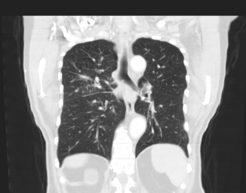 Bronchogenic carcinoma with lymphangitic spread (Radiopaedia 29002-29357 Coronal lung window 47).jpg