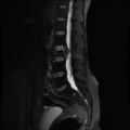 Burst fracture - lumbar spine (Radiopaedia 72877-83541 Sagittal STIR 6).jpg
