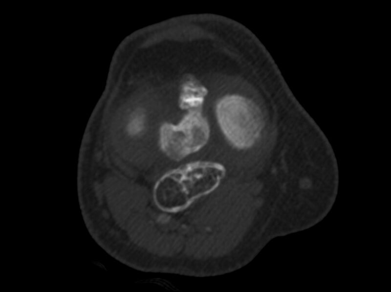 File:Calcified hematoma - popliteal fossa (Radiopaedia 63938-72763 C 23).jpg