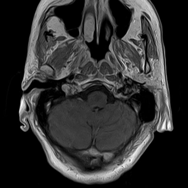 File:Calcified meningioma - cervical canal (Radiopaedia 70136-82468 Axial T1 C+ 3).jpg
