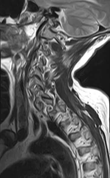 File:Calcified meningioma - cervical canal (Radiopaedia 70136-82468 Sagittal T2 12).jpg