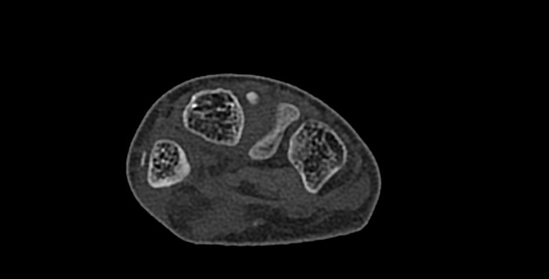 File:Calcifying aponeurotic fibroma (Radiopaedia 88423-105064 Axial bone window 113).jpg