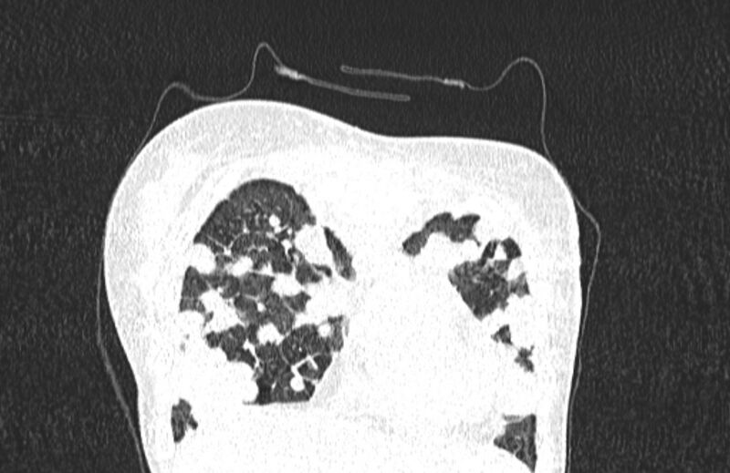 File:Cannonball metastases from breast cancer (Radiopaedia 91024-108569 Coronal lung window 22).jpg