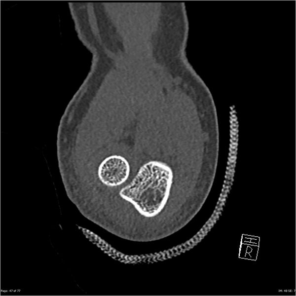 File:Capitellum fracture (Radiopaedia 23352-23426 Coronal bone window 47).jpg