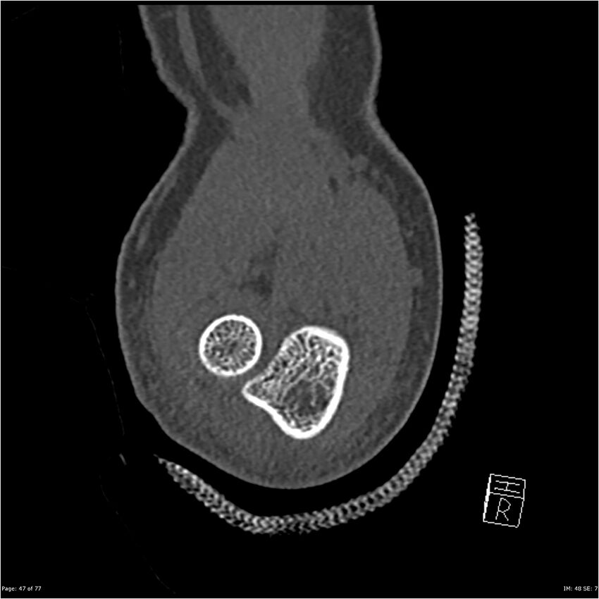 Capitellum fracture (Radiopaedia 23352-23426 Coronal bone window 47).jpg