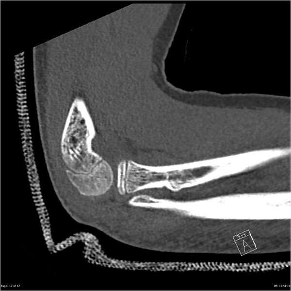 File:Capitellum fracture (Radiopaedia 23352-23426 Sagittal bone window 17).jpg