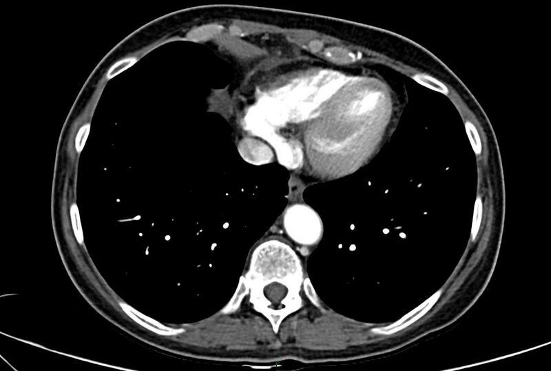 File:Carcinoid mesenteric tumor complicated by chylous ascites (Radiopaedia 76312-88926 A 1).jpg