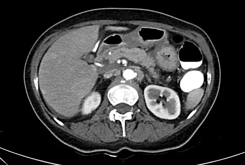 File:Carcinoid mesenteric tumor complicated by chylous ascites (Radiopaedia 76312-88926 A 23).jpg