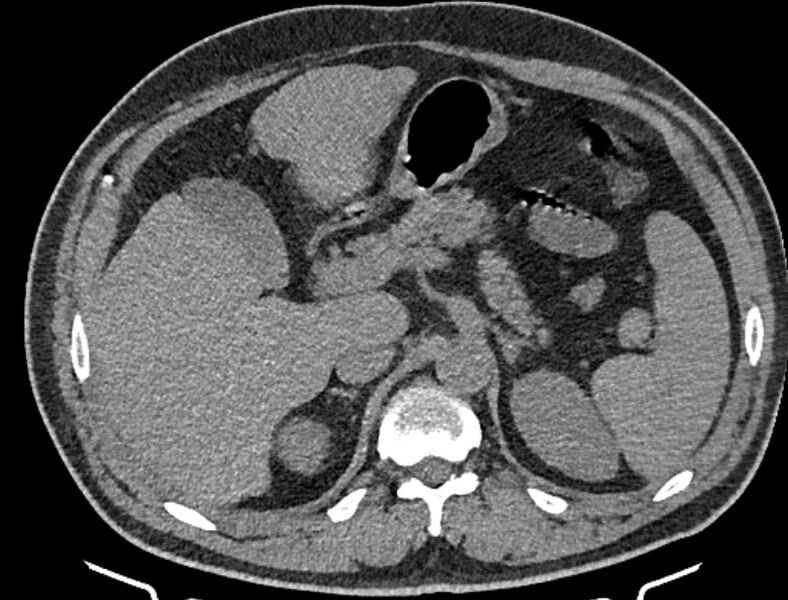 File:Cardiogenic pulmonary edema (Radiopaedia 68180-77678 Axial non-contrast 65).jpg