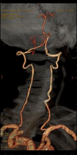 File:Carotid artery stenosis (Radiopaedia 28786-29086 B 13).jpg