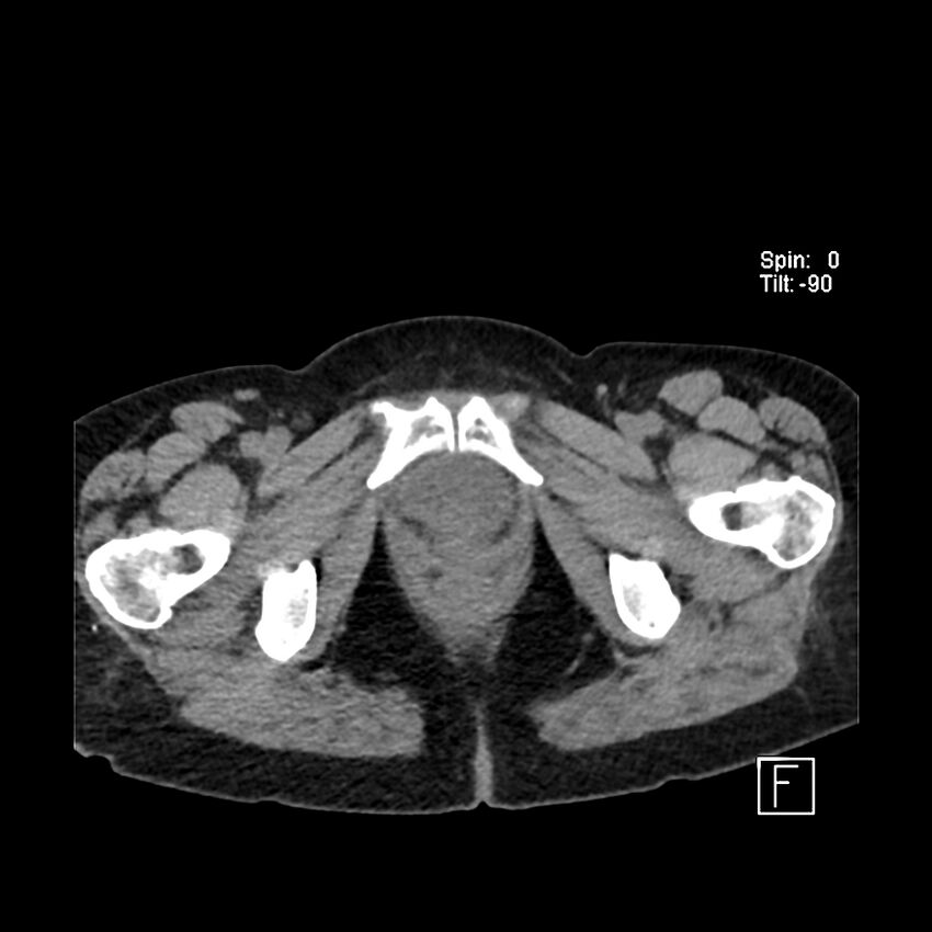 Cecal volvulus (Radiopaedia 90897-108397 Axial non-contrast 70).jpg