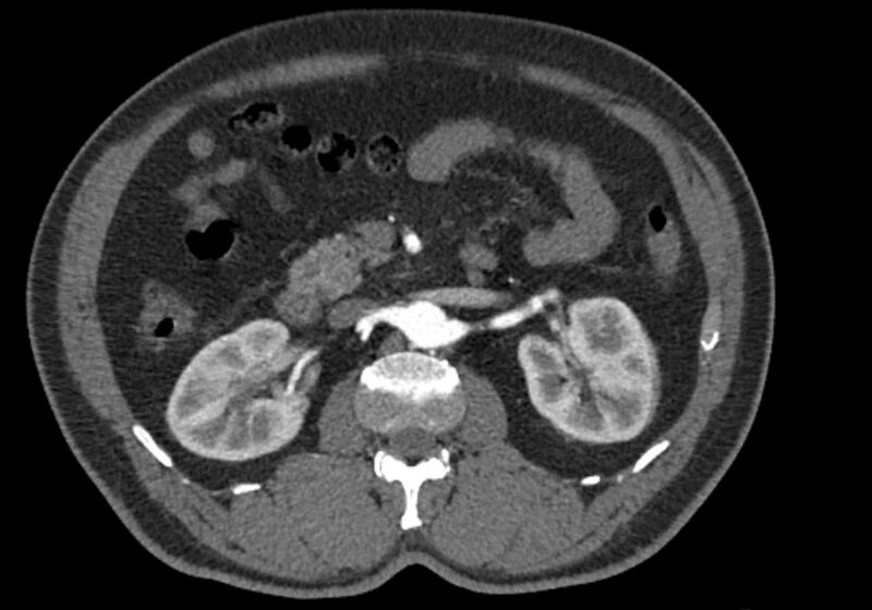 File:Celiac artery dissection (Radiopaedia 52194-58080 A 42).jpg