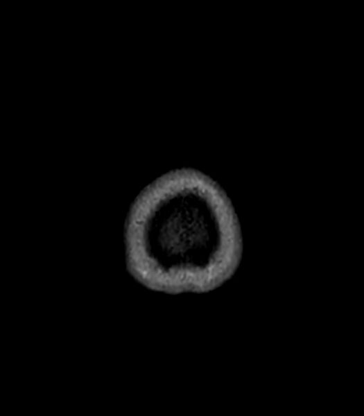 File:Central neurocytoma (Radiopaedia 79320-92380 Axial FLAIR 19).jpg