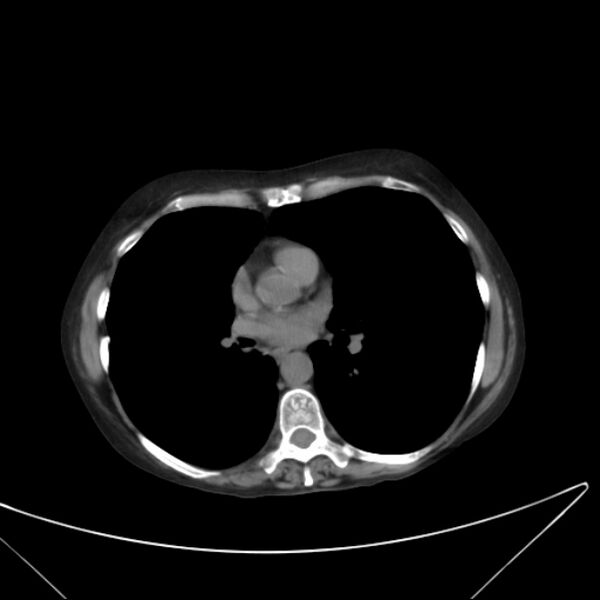 File:Centrilobular pulmonary emphysema (Radiopaedia 24495-24789 Axial non-contrast 27).jpg