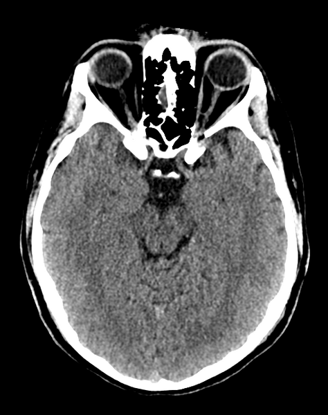 File:Cerebellar infarct due to vertebral artery dissection with posterior fossa decompression (Radiopaedia 82779-97033 Axial non-contrast 15).png
