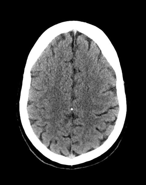 File:Cerebellar infarct due to vertebral artery dissection with posterior fossa decompression (Radiopaedia 82779-97033 Axial non-contrast 27).png