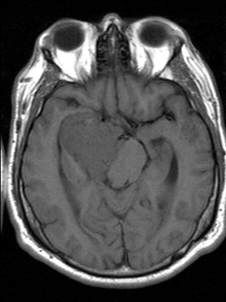 File:Cerebellopontine angle meningioma (Radiopaedia 24459-24764 Axial T1 9).jpg