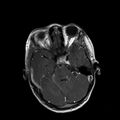 Cerebral abscess post cardiac surgery (Radiopaedia 27244-27420 Axial T1 C+ 5).jpg