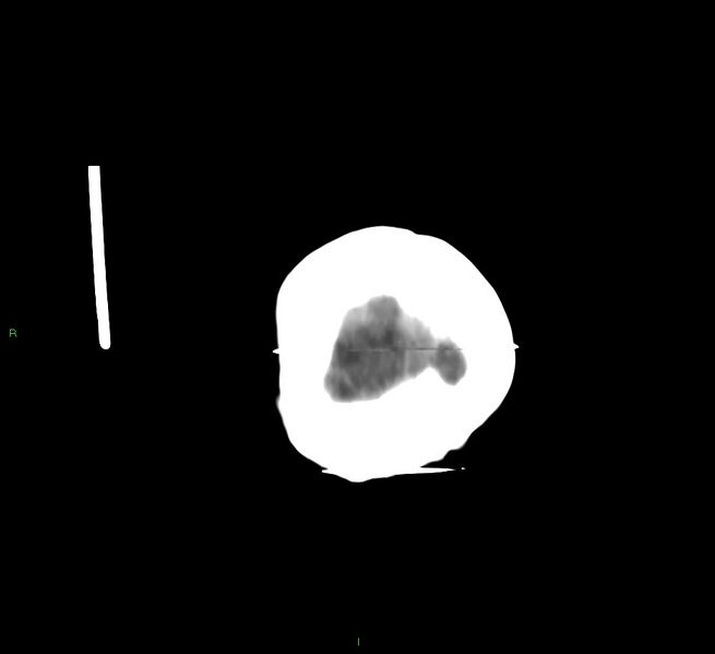 File:Cerebral amyloid angiopathy-associated lobar intracerebral hemorrhage (Radiopaedia 58377-65514 Coronal non-contrast 5).jpg