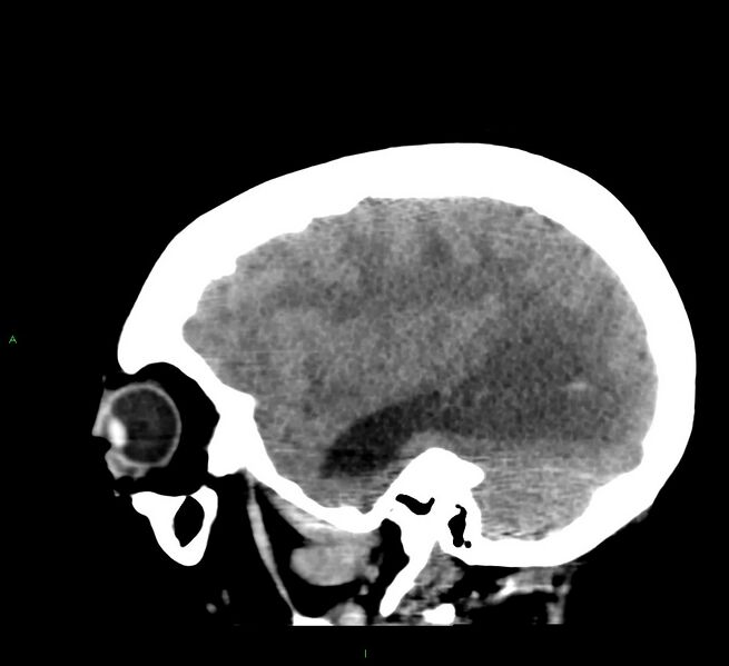 File:Cerebral amyloid angiopathy-associated lobar intracerebral hemorrhage (Radiopaedia 58379-65519 C 40).jpg