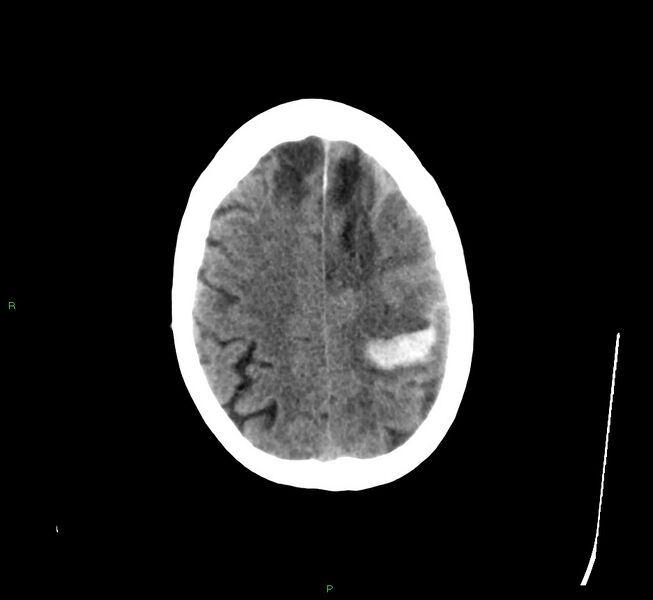 File:Cerebral amyloid angiopathy-associated lobar intracerebral hemorrhage (Radiopaedia 58529-65681 Axial non-contrast 13).jpg