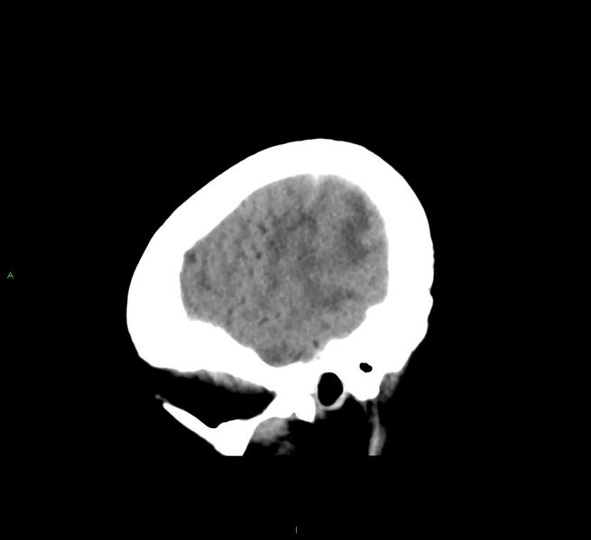 File:Cerebral amyloid angiopathy-associated lobar intracerebral hemorrhage (Radiopaedia 58563-65727 C 10).jpg