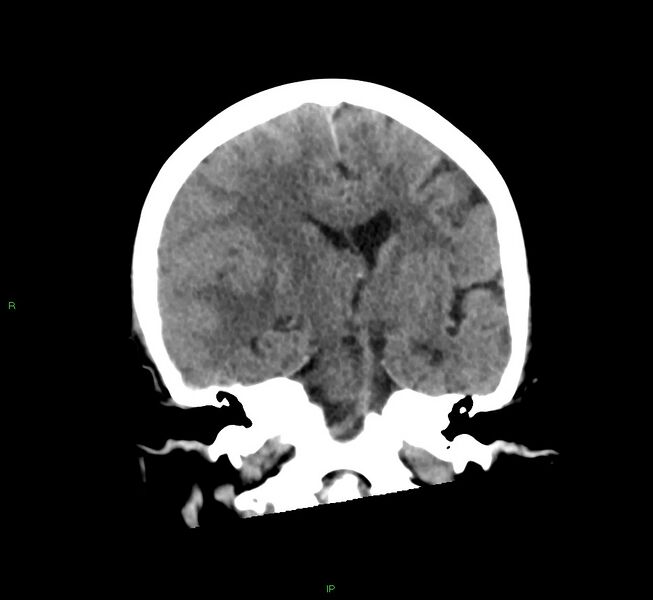 File:Cerebral amyloid angiopathy-associated lobar intracerebral hemorrhage (Radiopaedia 58563-65727 Coronal non-contrast 36).jpg