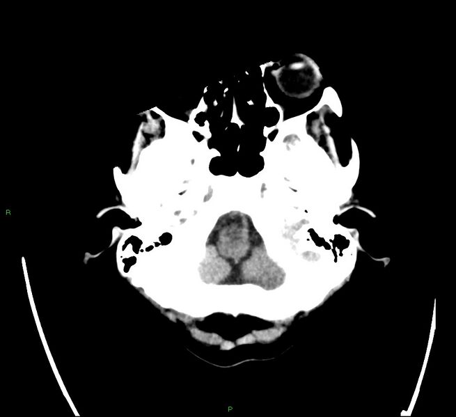 File:Cerebral amyloid angiopathy-associated lobar intracerebral hemorrhage (Radiopaedia 58566-65731 Axial non-contrast 3).jpg