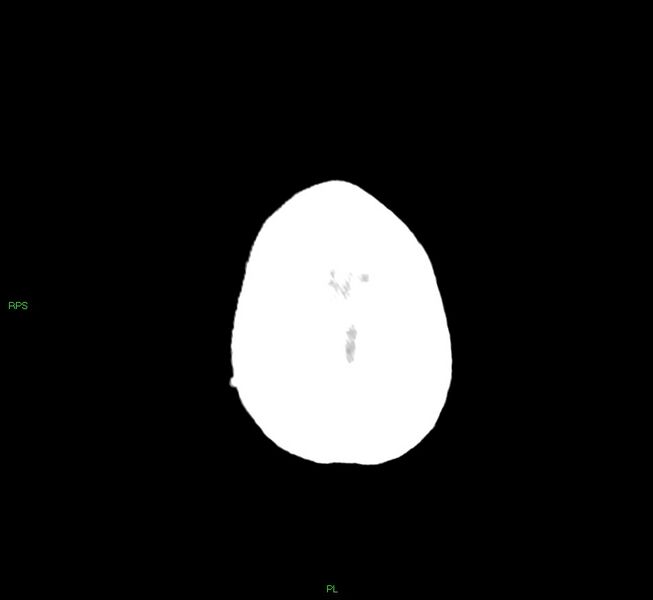 File:Cerebral amyloid angiopathy-associated lobar intracerebral hemorrhage (Radiopaedia 58569-65734 Axial non-contrast 11).jpg