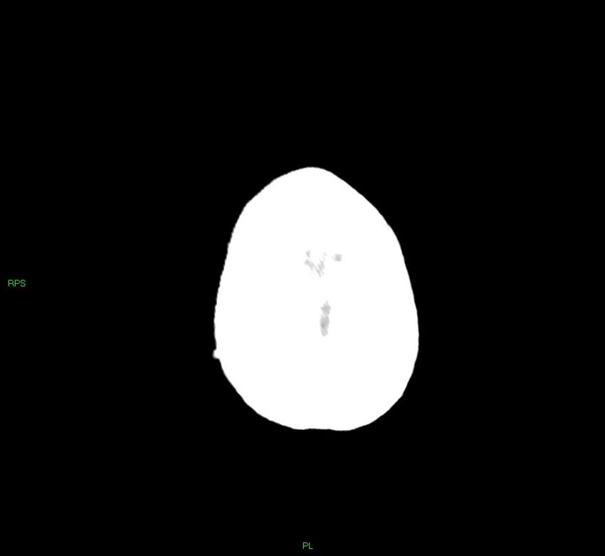 Cerebral amyloid angiopathy-associated lobar intracerebral hemorrhage (Radiopaedia 58569-65734 Axial non-contrast 11).jpg