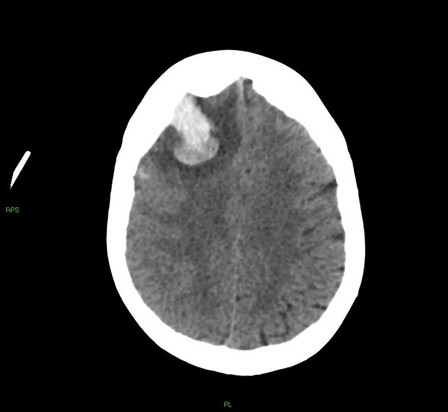 File:Cerebral amyloid angiopathy-associated lobar intracerebral hemorrhage (Radiopaedia 58569-65734 Axial non-contrast 23).jpg